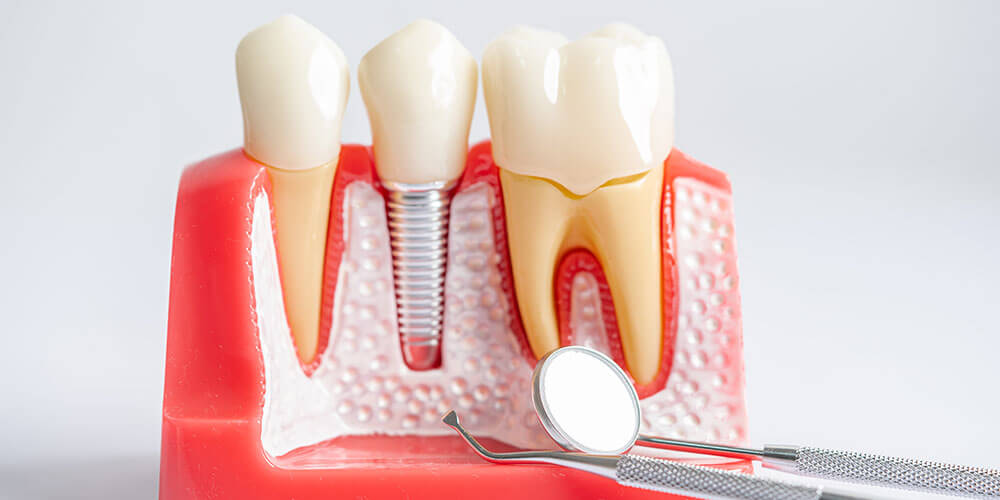 Dental Implants London
