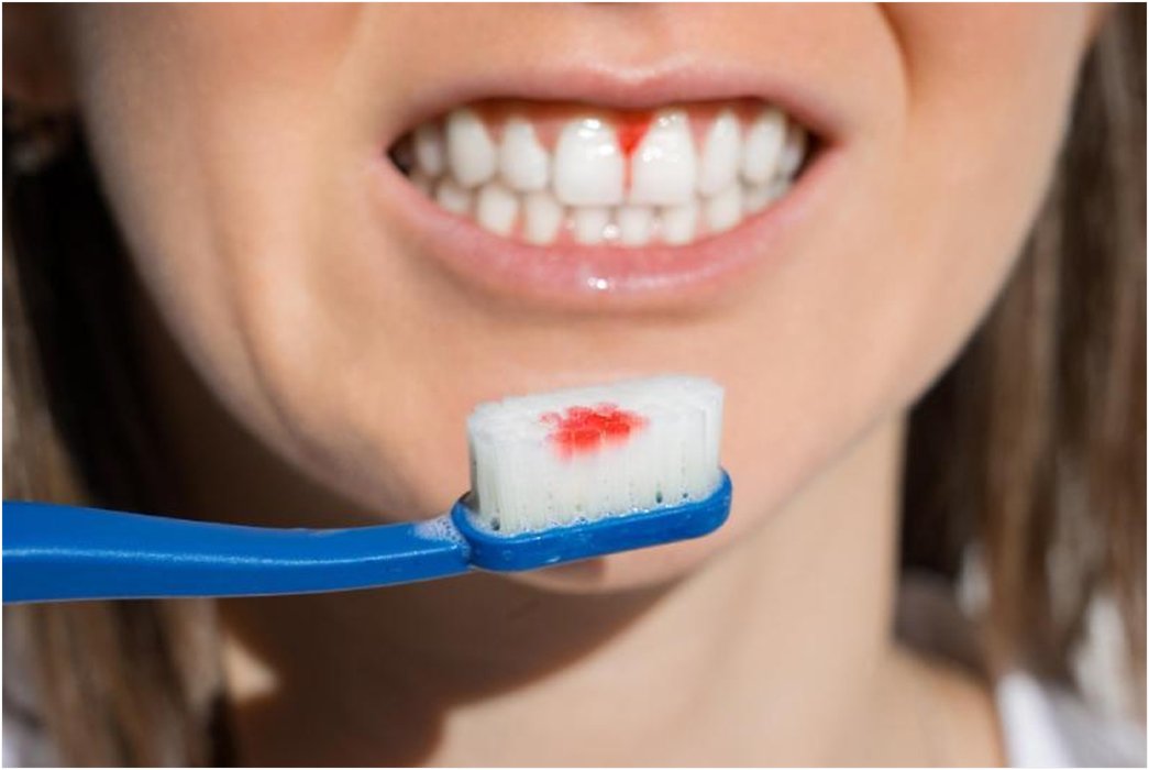 Bleeding Gums: What It Means and When to See a Dentist in London