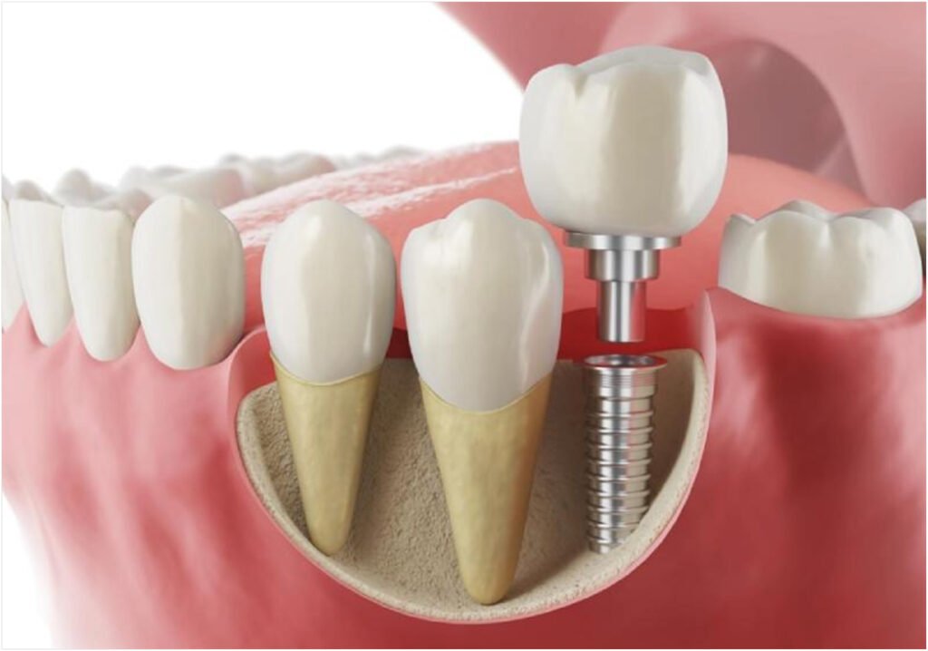 Dental Bridge vs. Implant: Comparing Your Options for a Single Missing Tooth