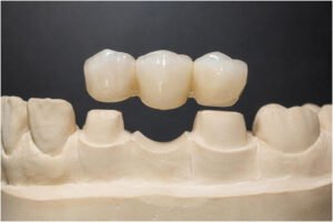 dental-bridge-just-dentistry