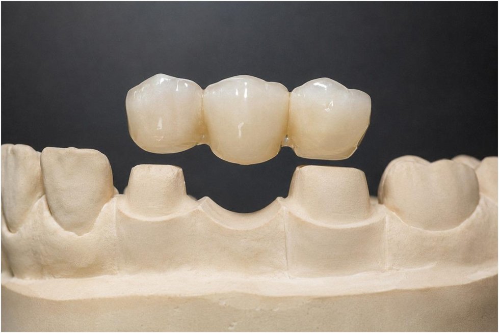 Dental Bridges Explained: How They Work and Who They’re For