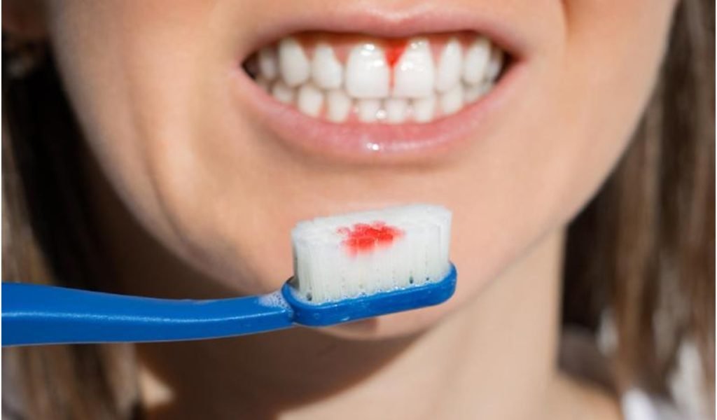Bleeding-gums