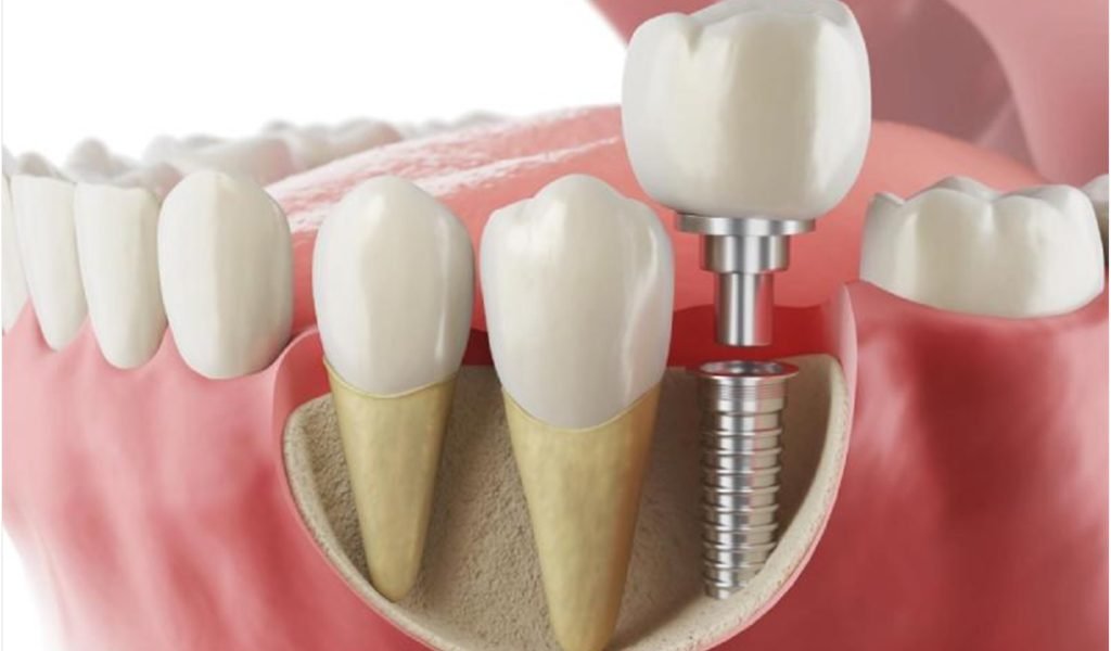 Dental-bridge-vs-implant